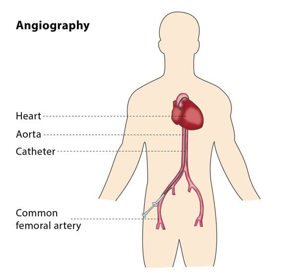 ANGIOGRAPHY TREATMENT SPECIALIST