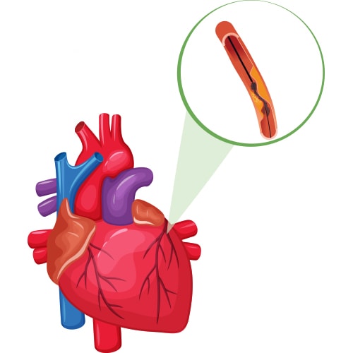 ANGIOGRAPHY TREATMENT SPECIALIST